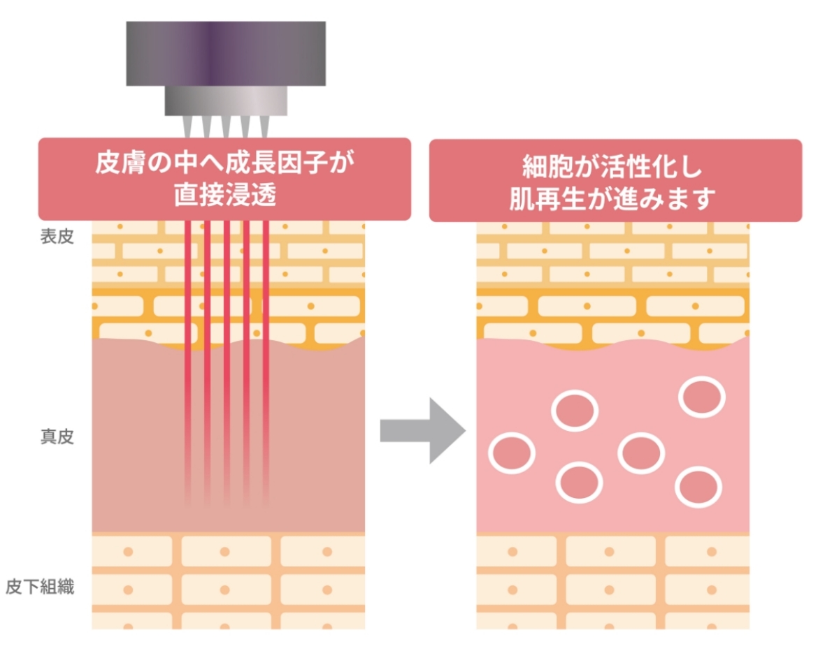 ダーマペンの仕組み