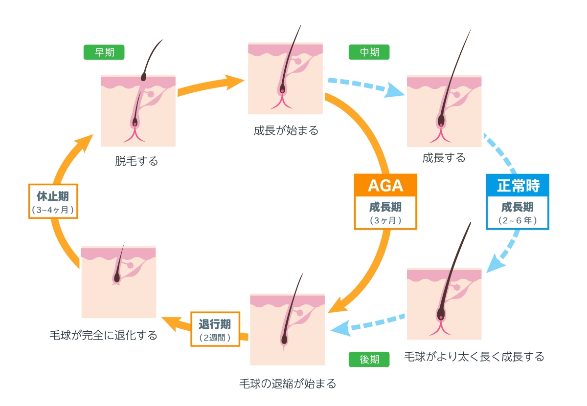 AGAの原因