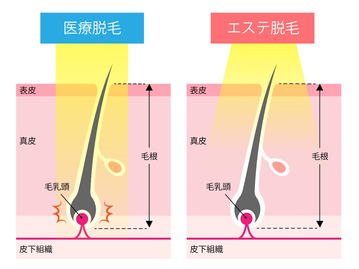 エステ脱毛医療脱毛の違い